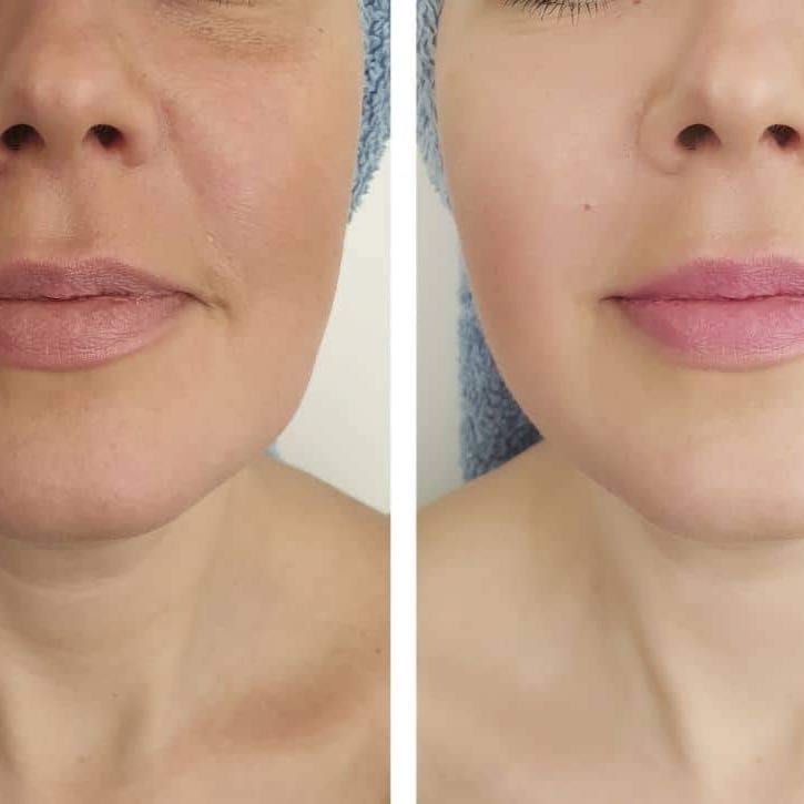 Skóra twarzy i szyi po zabiegu skinboosterem – efekt